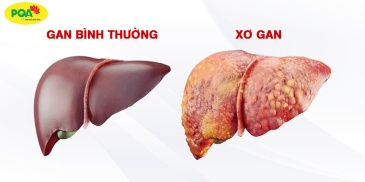 Xơ gan: Nỗi ám ảnh thầm lặng và những điều cần biết